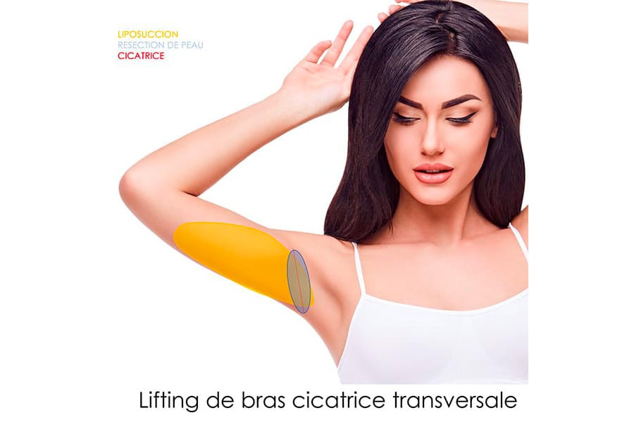 abdominoplastie un an apres chirurgie ventre chirurgie esthetique paris dr philippe pelissier chirurgien plasticien esthetique paris