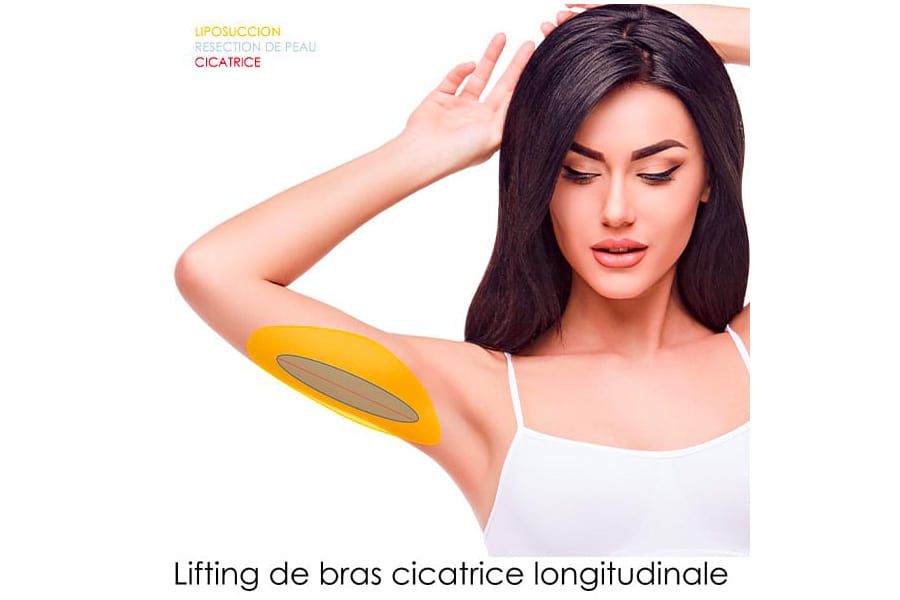 abdominoplastie un an apres chirurgie ventre chirurgie esthetique paris dr philippe pelissier chirurgien plasticien esthetique paris