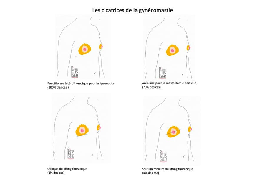 remplacement prothese mammaire prix chirurgie mammaire chirurgie esthetique paris dr philippe pelissier chirurgien plasticien esthetique paris