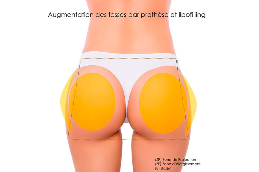 remplacement prothese mammaire prix chirurgie mammaire chirurgie esthetique paris dr philippe pelissier chirurgien plasticien esthetique paris