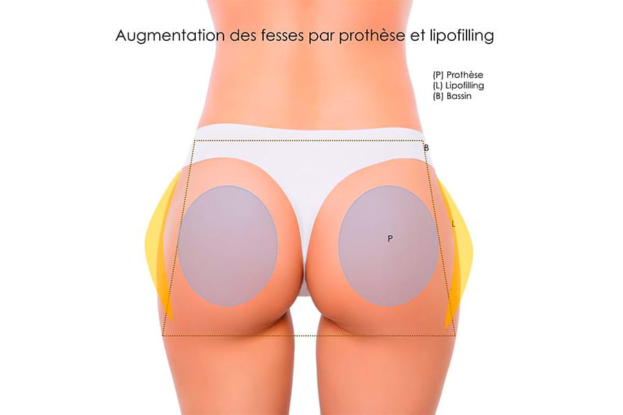 remplacement prothese mammaire prix chirurgie mammaire chirurgie esthetique paris dr philippe pelissier chirurgien plasticien esthetique paris