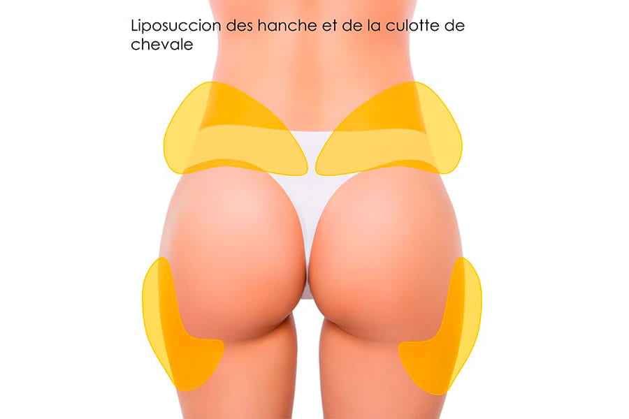 remplacement prothese mammaire prix chirurgie mammaire chirurgie esthetique paris dr philippe pelissier chirurgien plasticien esthetique paris