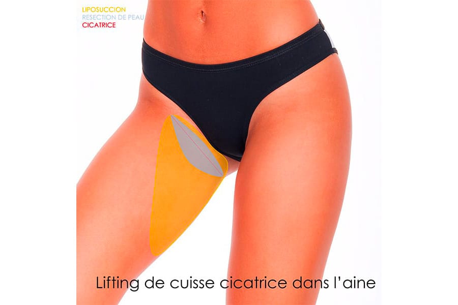 remplacement prothese mammaire prix chirurgie mammaire chirurgie esthetique paris dr philippe pelissier chirurgien plasticien esthetique paris