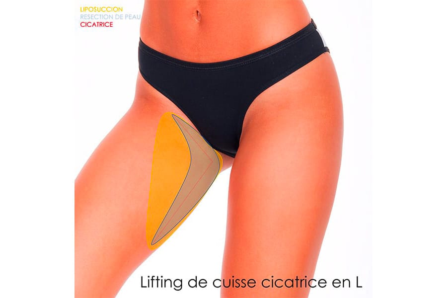remplacement prothese mammaire prix chirurgie mammaire chirurgie esthetique paris dr philippe pelissier chirurgien plasticien esthetique paris