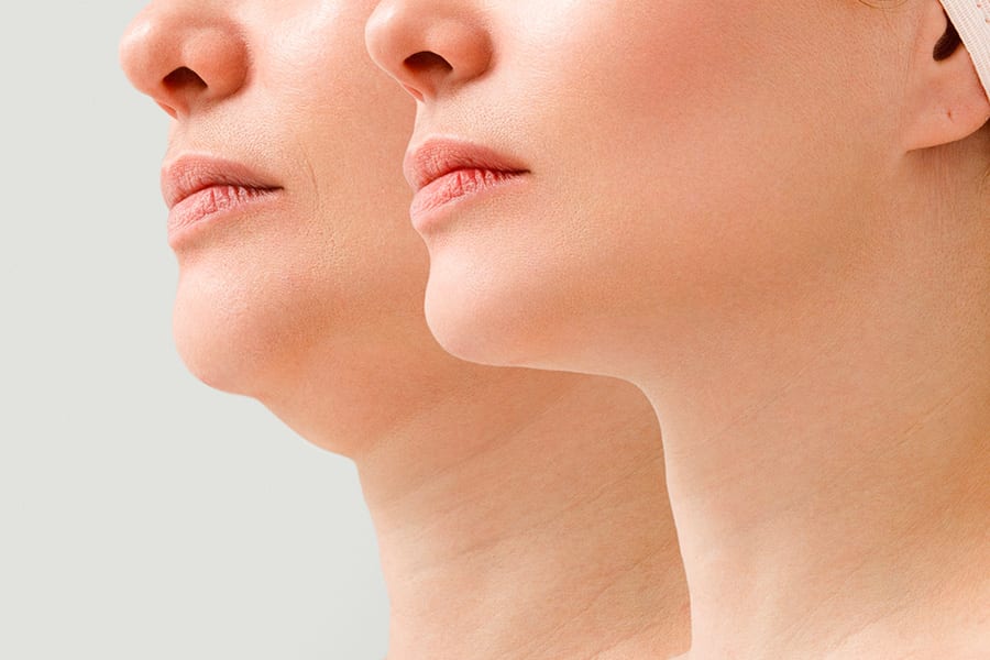 abdominoplastie un an apres chirurgie ventre chirurgie esthetique paris dr philippe pelissier chirurgien plasticien esthetique paris